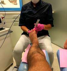 Tratamiento hongos y papilomas pies Barcelona